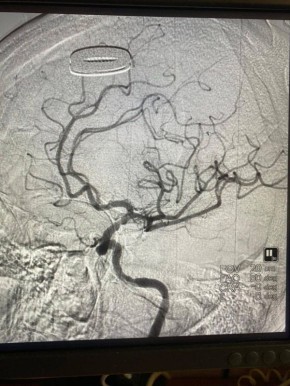За жизнь липчанки с обширным поражением мозговых тканей три недели боролись врачи ЛОКБ