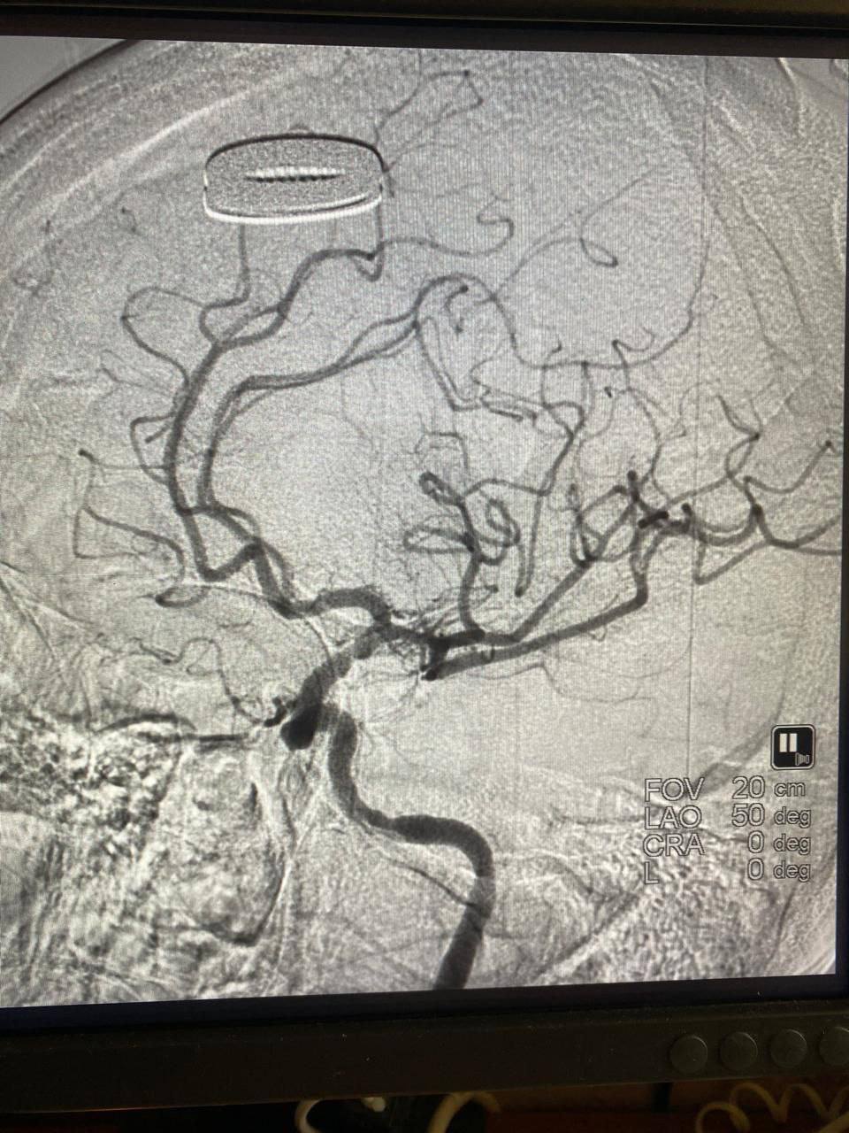 За жизнь липчанки с обширным поражением мозговых тканей три недели боролись врачи ЛОКБ