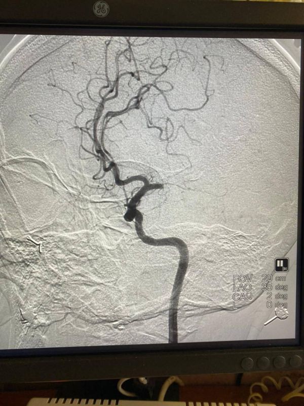 За жизнь липчанки с обширным поражением мозговых тканей три недели боролись врачи ЛОКБ За жизнь липчанки с обширным поражением мозговых тканей три недели боролись врачи ЛОКБ