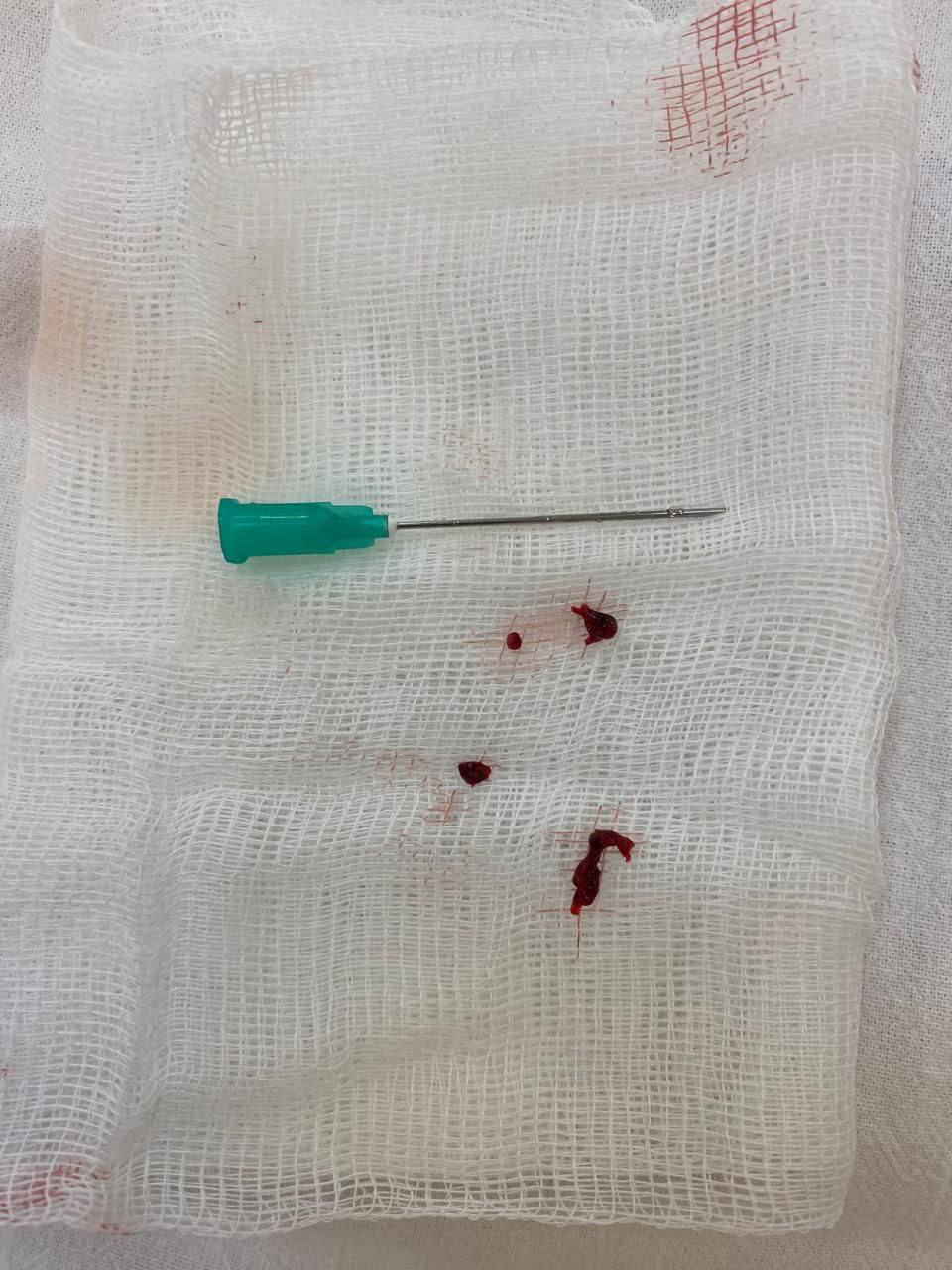 За жизнь липчанки с обширным поражением мозговых тканей три недели боролись врачи ЛОКБ За жизнь липчанки с обширным поражением мозговых тканей три недели боролись врачи ЛОКБ