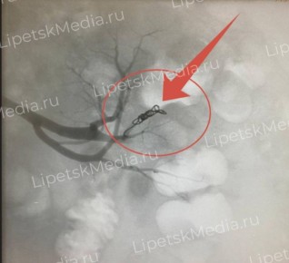 От почечных кровотечений долгое время страдал липчанин