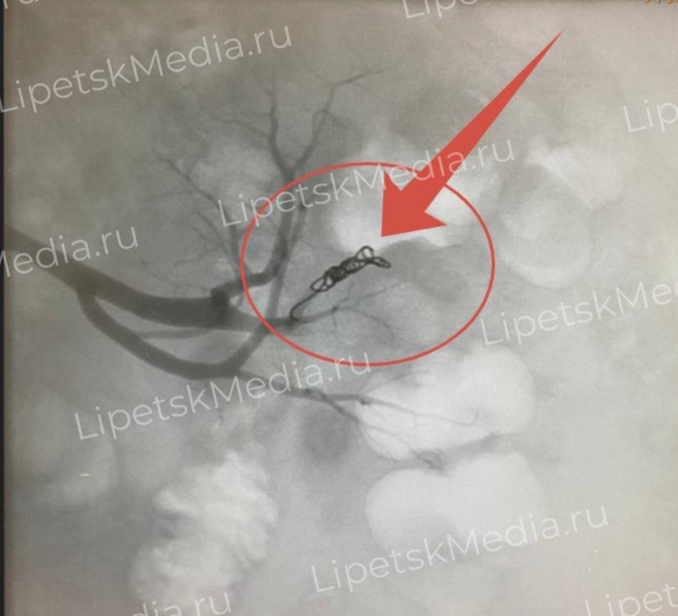 От почечных кровотечений долгое время страдал липчанин