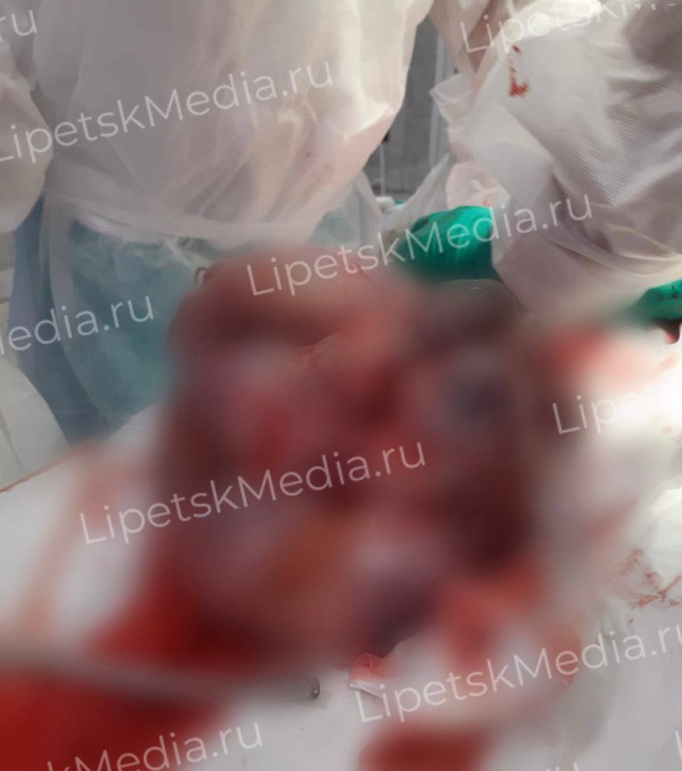 Опухоль яичника размером с небольшой чемодан удалили пациентке липецкие медики