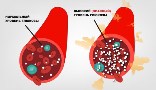 Скрытые угрозы: как предиабет может оставаться незамеченным