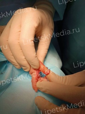 Шестые пальчики более 10 лет удаляют в Липецкой областной больнице