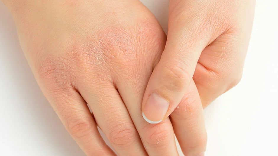 Зимнее спасение для сухих рук: простые домашние способы увлажнения