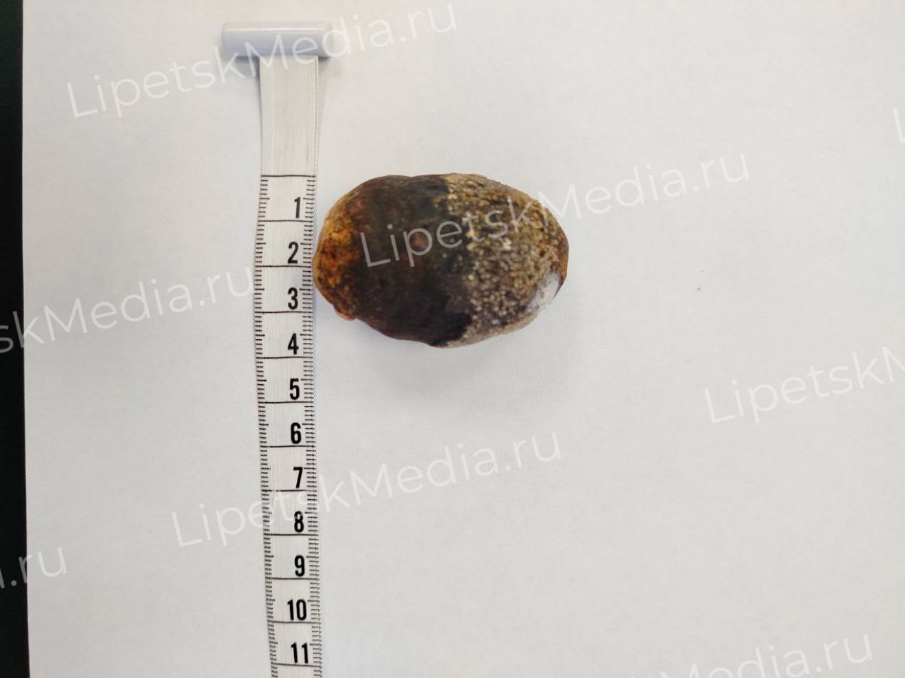 Блуждающий желчный камень удалили из кишечника пенсионерки Блуждающий желчный камень удалили из кишечника пенсионерки