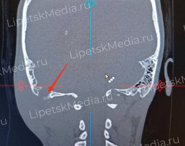 Многодетную маму с абсцессом заушной полости спасли липецкие отоларингологи