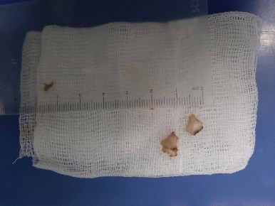 Поперхнувшегося грецким орехом двухлетнего малыша спасли липецкие врачи